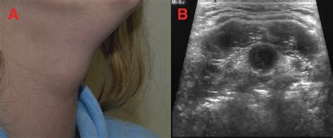 Neck Lipoma Ultrasound Images - Infoupdate.org