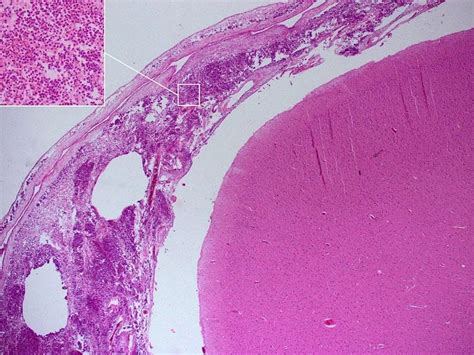 ¿Qué sabes sobre la meningitis?