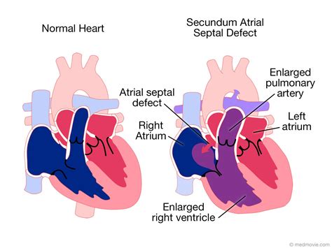 Pin on Atrial Septal Defect (ASD)