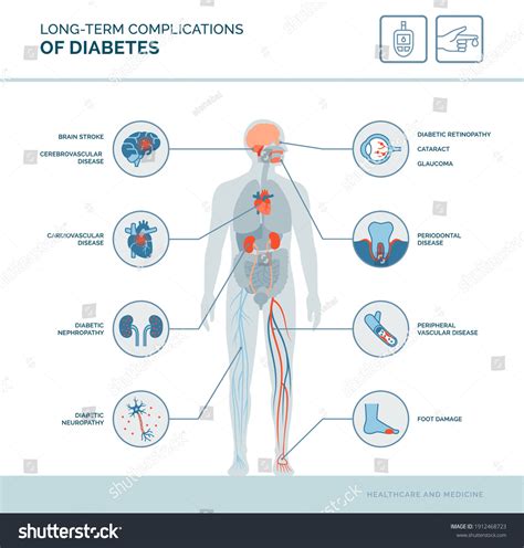 880 Diabetes complications 图片、库存照片和矢量图 | Shutterstock