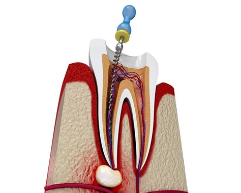 Layanan Root Canal Treatment Profesional - mydents dental care