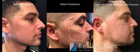 Fraxel Laser Results for Acne Scars on Hispanic Skin Before & After ...