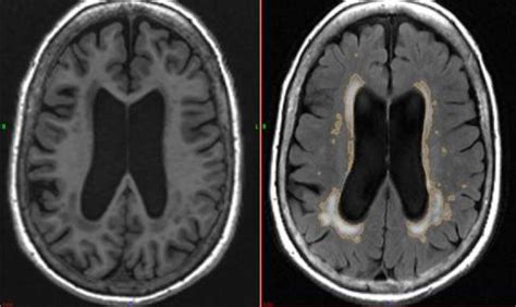 white matter disease mri Mri lesions diffuse axial - Diseases Club center