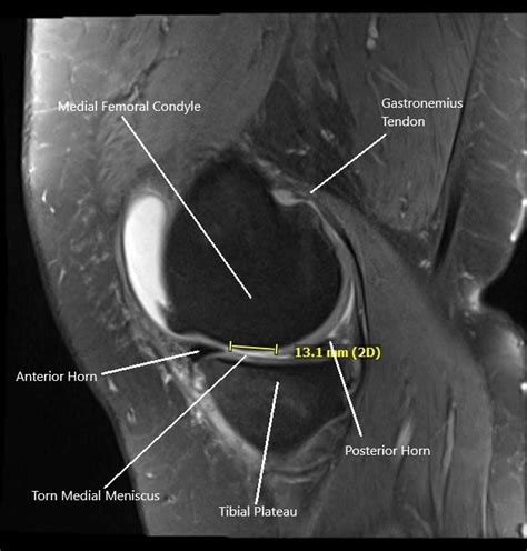 Grade 2 Meniscus Tear