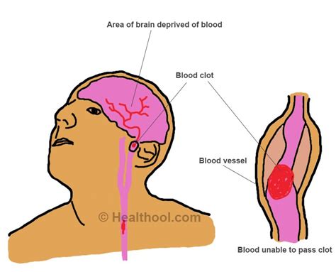 Blood Clots in the Brain - Symptoms, Causes, Treatment