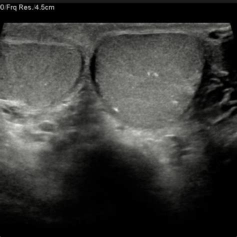 Testicular teratoma in a 16-year-old teenager | Eurorad