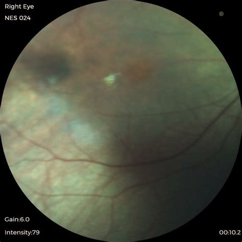 Right eye iris nevus (arrow) | Download Scientific Diagram