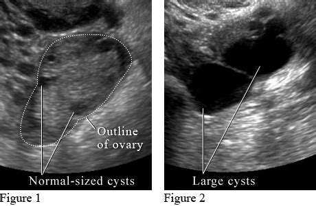 Ultrasound of Ovarian Cysts | University of Michigan Health System