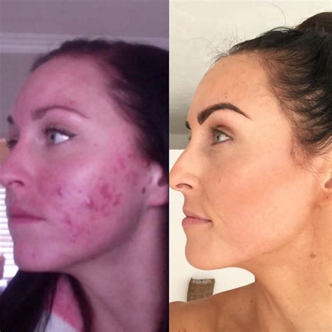 This food blogger kept it real about her cystic acne scars in this powerful before and after post