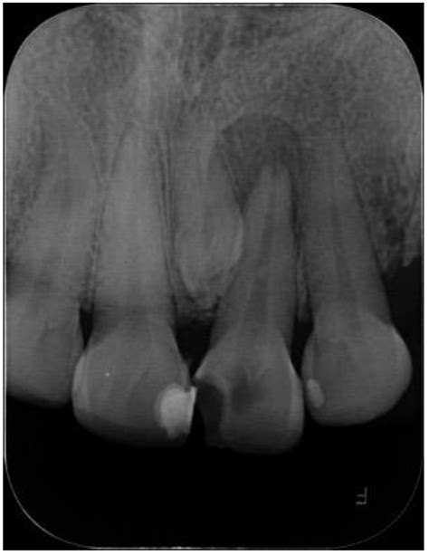 Diagnostics | Free Full-Text | Non-Syndromic Familial Mesiodens: Presentation of Three Cases