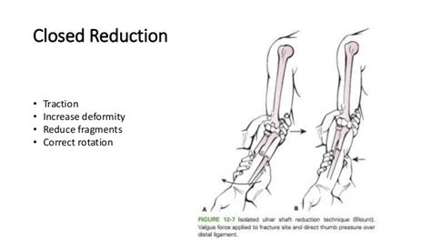 General Principles - Pediatric Fracture Management | Epomedicine