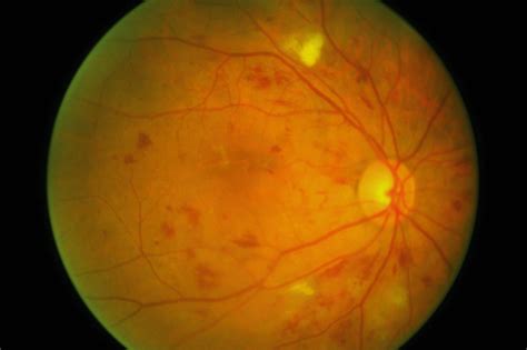 Diabetic Retinopathy | Clinical Features | Geeky Medics