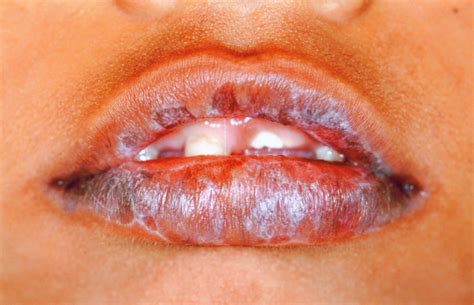 Lichen Planus Lips