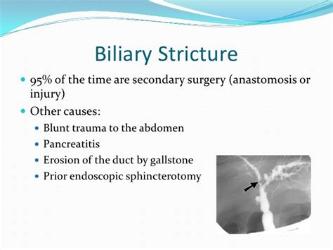 Biliary Disease