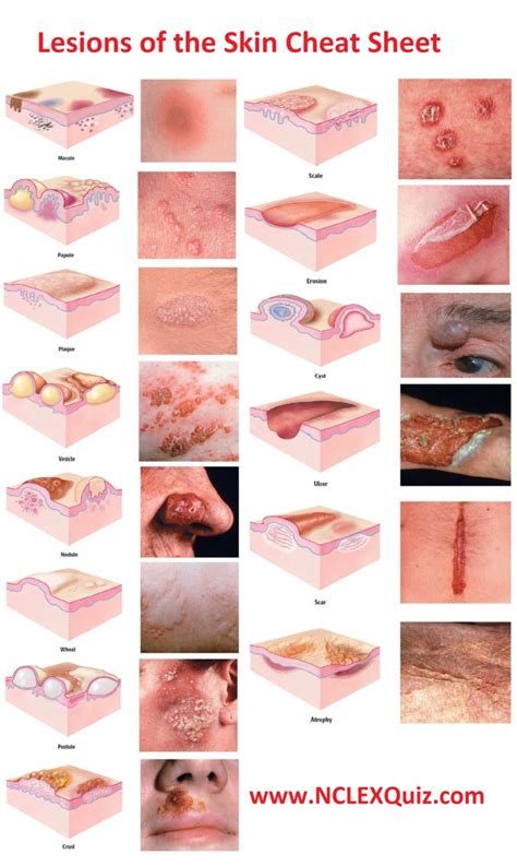 Classification Of Skin Lesions Futuredentalhygienist Nurse Nursing ...