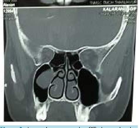 Figure 2 from A Loculated Pyocele of Maxillary Sinus—A Rare Case Report ...