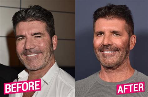 Simon Cowell Plastic Surgery Makeover Exposed By Top Docs