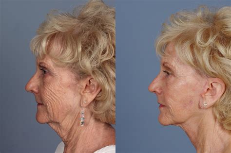 Possible Risks of Facelift Surgery