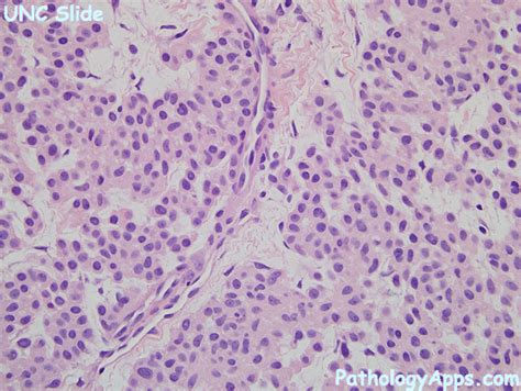 glomus tumor pathology