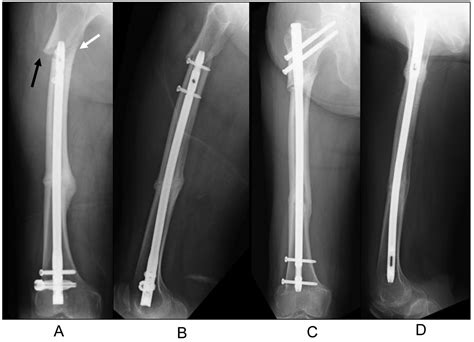 Periprosthetic Fracture Resembling Atypical Femoral Fracture After Fixation With Retrograde ...