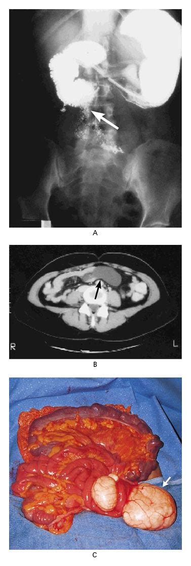 Mesenteric Cyst | NEJM