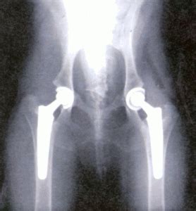 Complications of Total Hip Replacement Surgery/Total Hip Arthroplasty