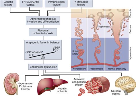 Placental growth factor in pre-eclampsia: friend or foe? - Kidney International