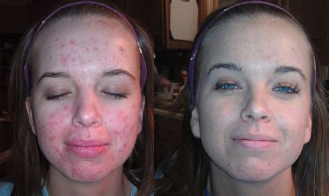 Acne - Before and After Results | Osmosis Skincare Manuka Honey Acne, Honey For Acne, Acne ...