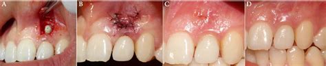 A) Periodontal flap to remove the granulation tissue and excess of the... | Download Scientific ...