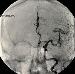 What if a Brain Aneurysm Is Coiled but Then Starts to Grow and Bleed Again - Robinson Ving1958