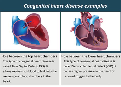 Congenital heart anomalies