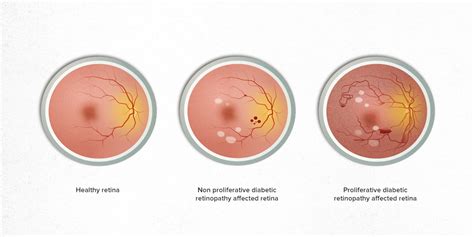 What is Diabetic Retinopathy?