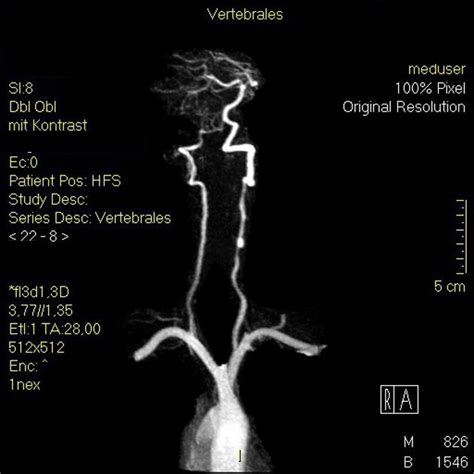 Vertebrobasilar insufficiency MRI - wikidoc