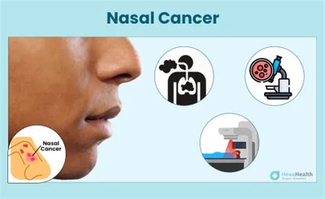 Nasal Cancer: Pictures, Symptoms, Causes and Treatment