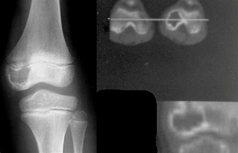 An 8-year-old boy with a 2-month history of knee pain and limping.... | Download Scientific Diagram