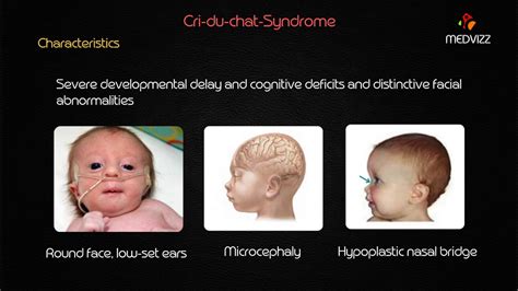 Cri-du-Chat Syndrome - Usmle step 1 lecture - YouTube