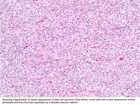 Pathology Outlines - Clear cell sarcoma