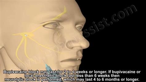 Trigeminal Nerve Block