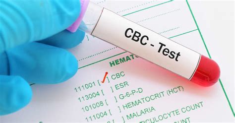 High MCHC: Causes, treatment, and symptoms