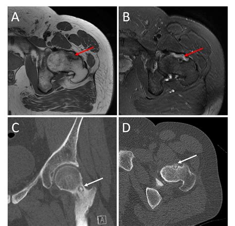 Figure 2 from Osteoid osteoma of the femoral neck mistaken as a ...