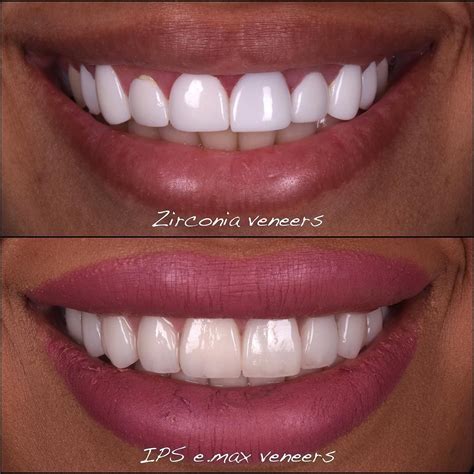 As a prosthodontist I had never seen zirconia laminate veneers before this young lady I removed ...