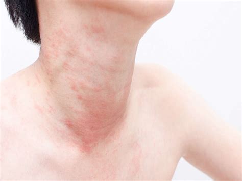 Hives: 10 Causes Of Hives