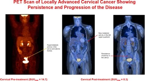 Positron emission tomography scan of locally advanced cervix cancer ...