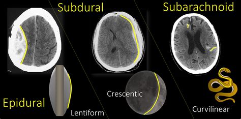 Subdural Hematoma Vs Subarachnoid Hemorrhage