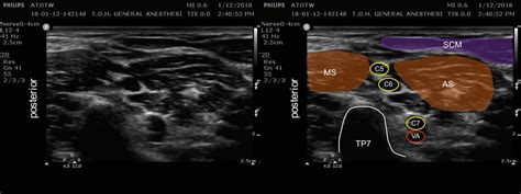 NEW ATOTW PUBLISHED: #400 Ultrasound-Guided Interscalene Block. This ...