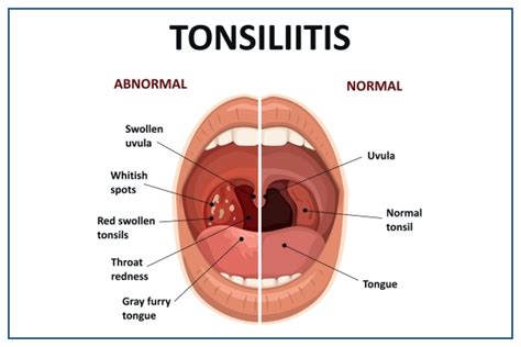 Tonsillitis Types, Causes, Symptoms, Complications,, 55% OFF