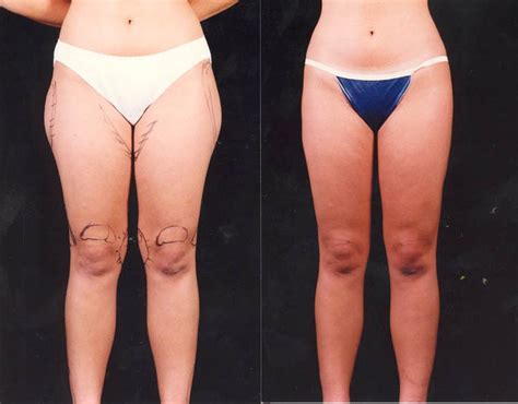 thigh, knee lipo | Thigh and Knee Liposuction | To Try in 2015 ...