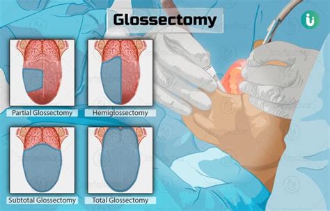 Glossectomy: Procedure, Purpose, Results, Cost, Price