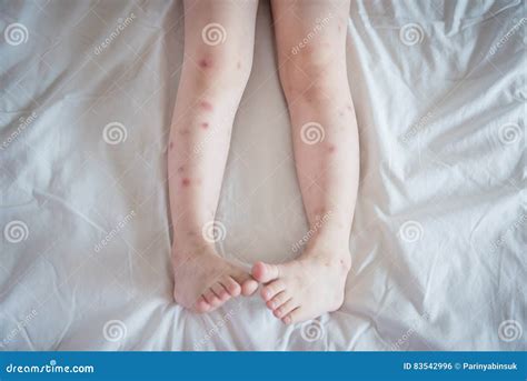 Mosquito Bites Sore and Scar on Child Legs Stock Photo - Image of ...