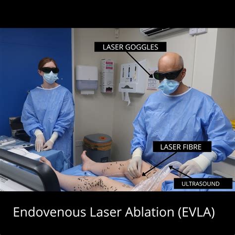 Endovenous Laser Ablation | The VeinCare Centre